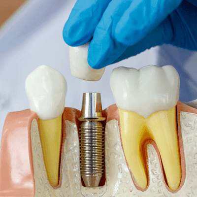 4 Types of Dental Implants