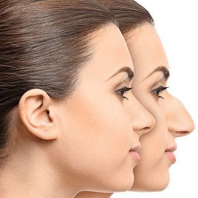 5 Facts About Non Surgical Nose Job