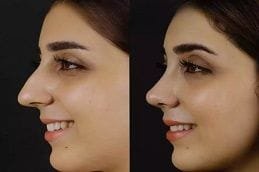 Alarplasty in Dubai 6 Alarplasty Dubai Before and After