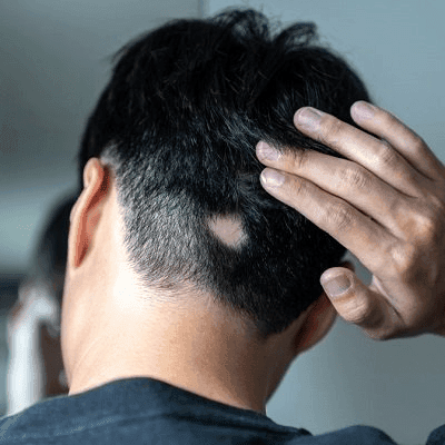 Alopecia Areata Can Patchy Hair Loss Be Treated