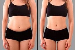 Aqualyx Injections 6 Aqualyx injections Before & After