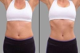 Aqualyx Injections 4 Before & After Aqualyx injections in Dubai