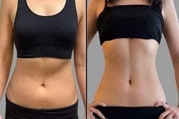 Aqualyx Injections 5 Before & After Aqualyx injections