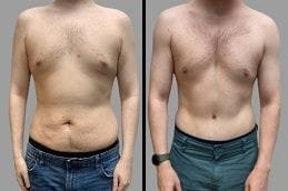 Before & After Body Contouring Dubai Silicon Oasis