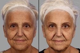 Botox Injection Dubai 6 Before & After Botox