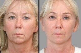 Face lift 4 Before & After Facelift in Dubai
