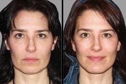 Face lift 6 Before & After Facelift