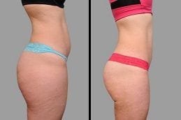 Before & After Fat Reduction Dubai Silicon Oasis
