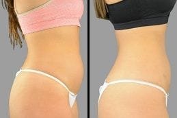Before & After Fat Reduction Silicon Oasis
