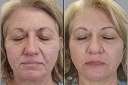 HIFU Treatment in Dubai 4 Before After HIFU Treatment
