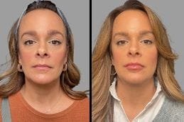 Before & After Lip Fillers Injections in Dubai