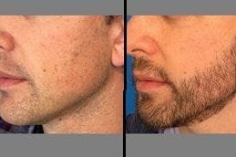 Mustache Hair Transplant in Dubai 4 Before & After Mustache Hair Transplant