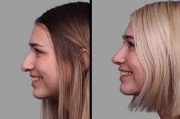 Before & After Rhinoplasty Dubai Silicon Oasis