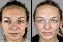 Before & After Salmon DNA Injection