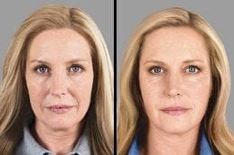 Before After Sunekos Injections