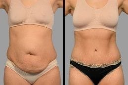 Tummy Tuck | Abdominoplasty 6 Before & After Tummy Tuck