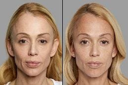 Volift Fillers 6 Before & After Volift Fillers