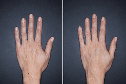 Before and After Hand Rejuvenation