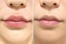 Lip Reduction 5 Before and After Lip Reduction in Dubai