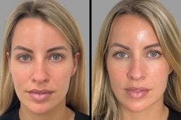 Before and After Sculptra Fillers