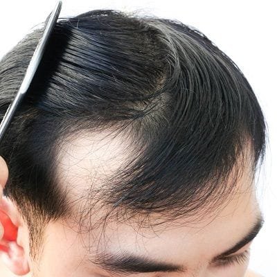 Benefits of laser hair therapy in Dubai & Abu Dhabi Dynamic Clinic