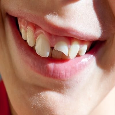 Best Broken Tooth Treatment in Dubai Abu Dhabi Cost