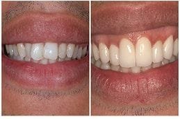 Best Ceramic Crowns Dubai