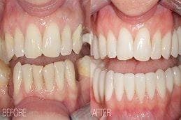 Best Ceramic Crowns in Abu Dhabi
