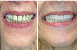 Best Ceramic Crowns in Dubai