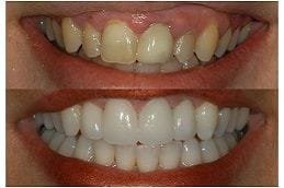 Best Gingivitis in Dubai & Abu Dhabi