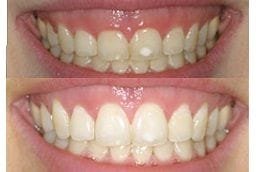 Best Gingivitis in Dubai