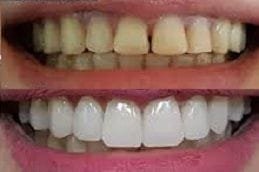 Zirconia Crown 3 Best Zirconia Crowns Dubai & Abu Dhabi