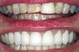 Zirconia Crown 2 Best Zirconia Crowns in Dubai