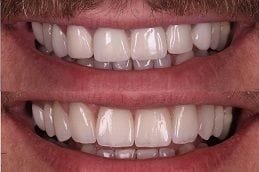 Zirconia Crown 1 Best Zirconia Crowns