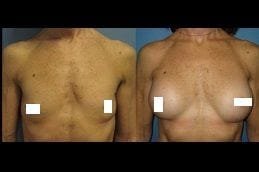 Breast Lift Surgery 6 Best breast-lift Clinic in Dubai