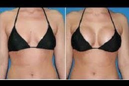 Breast Reconstruction 6 Best breast-reconstruction in Abu Dhabi