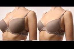 Breast Reduction Surgery 6 Best breast-reduction Clinic in Dubai