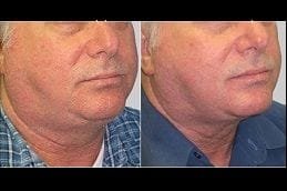 Exilis Treatment Dubai 6 Best exilis-treatment in Abu Dhabi