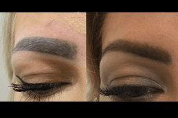 Best eyebrow-tattoo-removal Clinic in Dubai