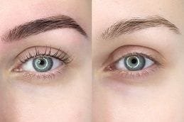 Best eyebrow-tattoo-removal in Abu Dhabi