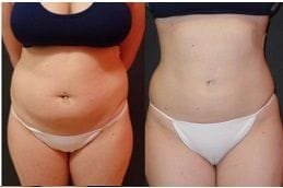 Best fat-transfer-surgery Clinic in Dubai