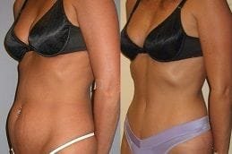 Best fat-transfer-surgery in Abu Dhabi