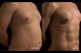 High Definition Liposculpture 5 Best high-definition-liposculpture Clinic in Dubai