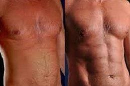 High Definition Liposculpture 4 Best high-definition-liposculpture in Abu Dhabi