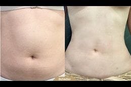 Best lipomatic-treatment Clinic in Dubai