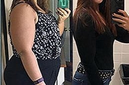 Mini Gastric Bypass 4 Best mini-gastric-bypass Clinic in Dubai