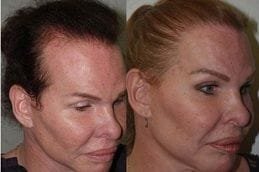 Natural Hairline Treatment 4 Best natural-hairline-treatment in Abu Dhabi