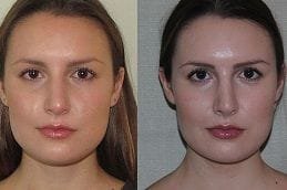 Best septoplasty-turbinate-reduction Clinic in Dubai