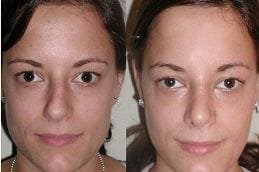 Best septoplasty-turbinate-reduction in Abu Dhabi