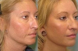 Silhouette Facelift 6 Best silhouette-facelift in Abu Dhabi
